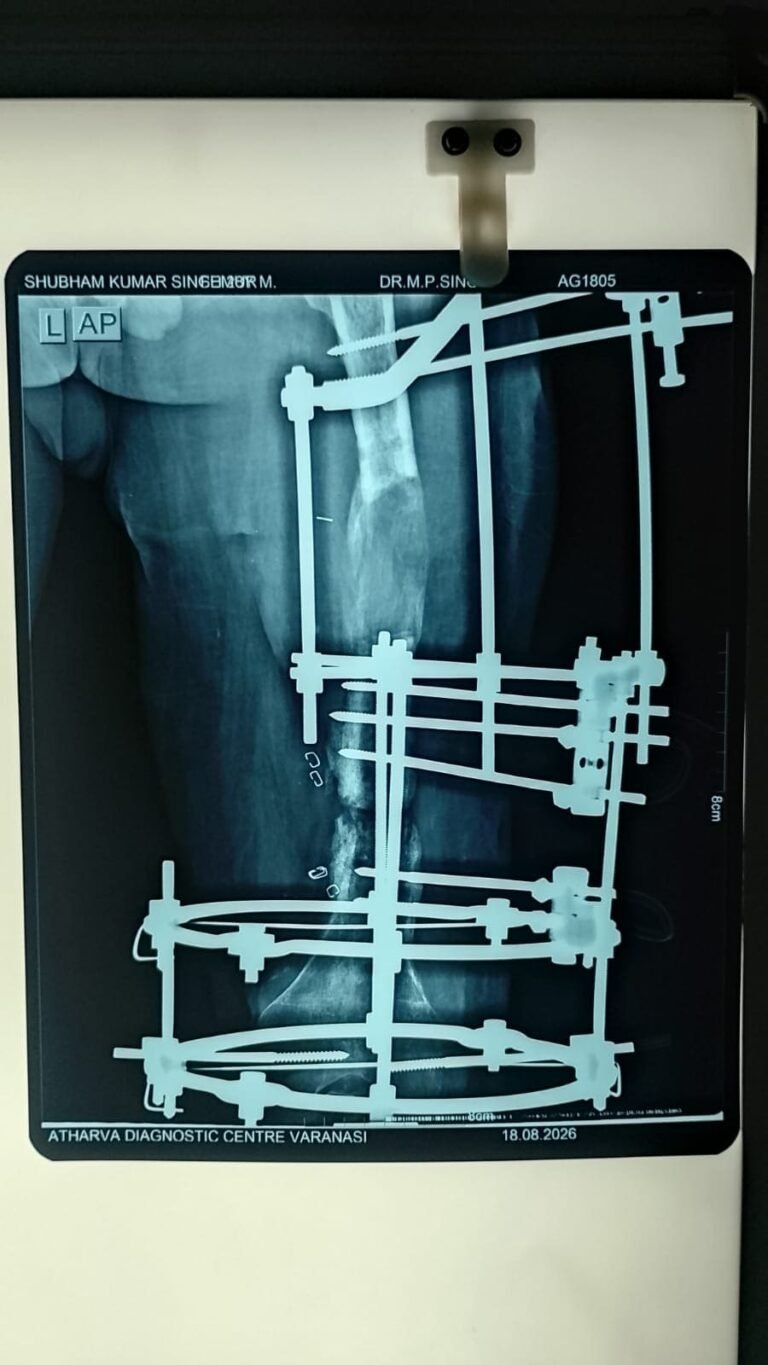 WITH NEW LENGTHENED THIGH BONE