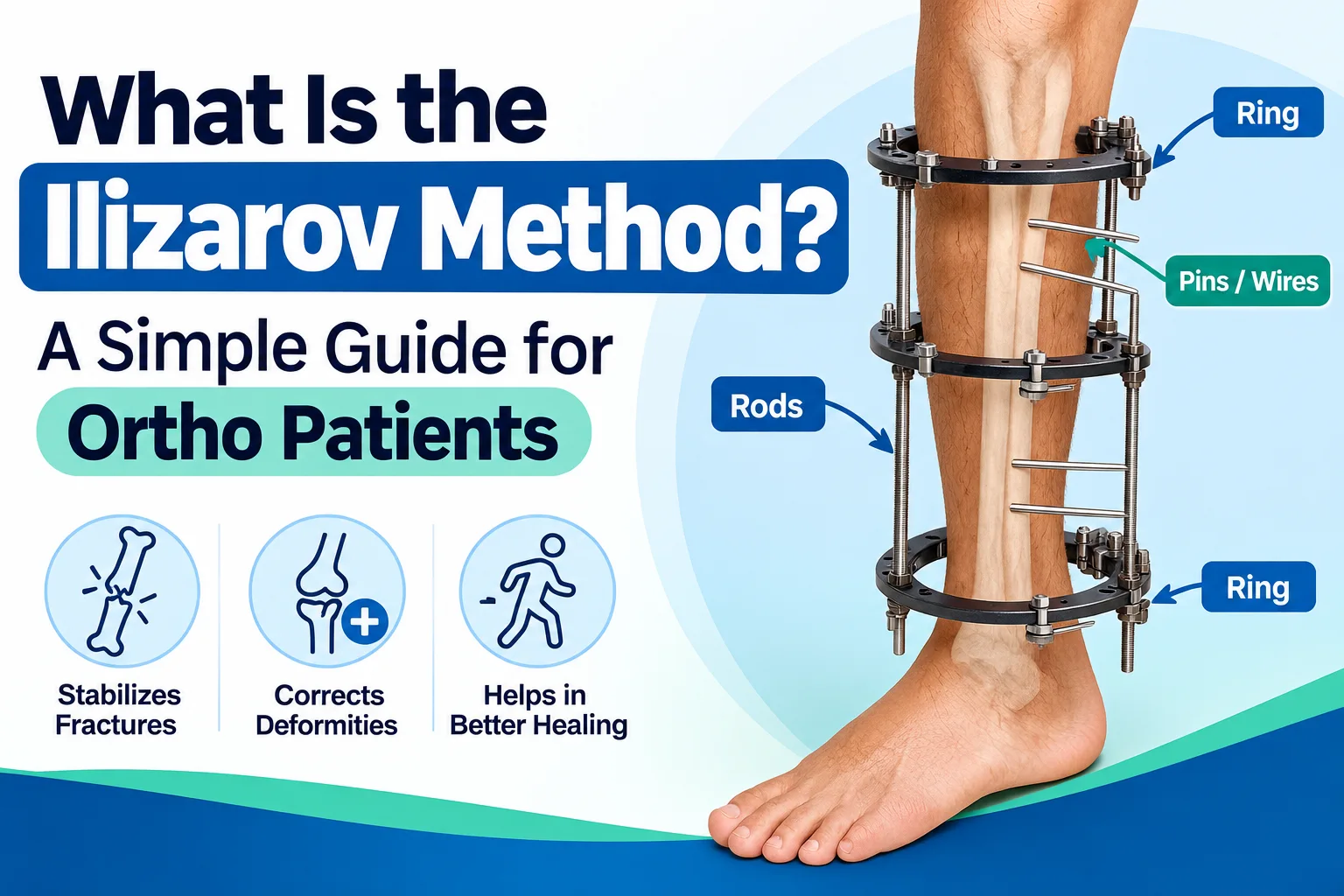 Ilizarov frame explained: How it lengthens, straightens & rebuilds bone